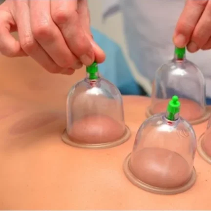 cupping therapy1